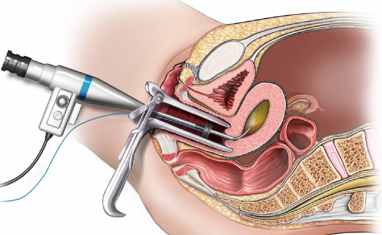 Hysteroscopy Treatment of Infertility