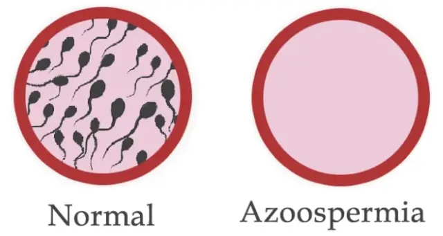Azoospermia Treatment in Chennai