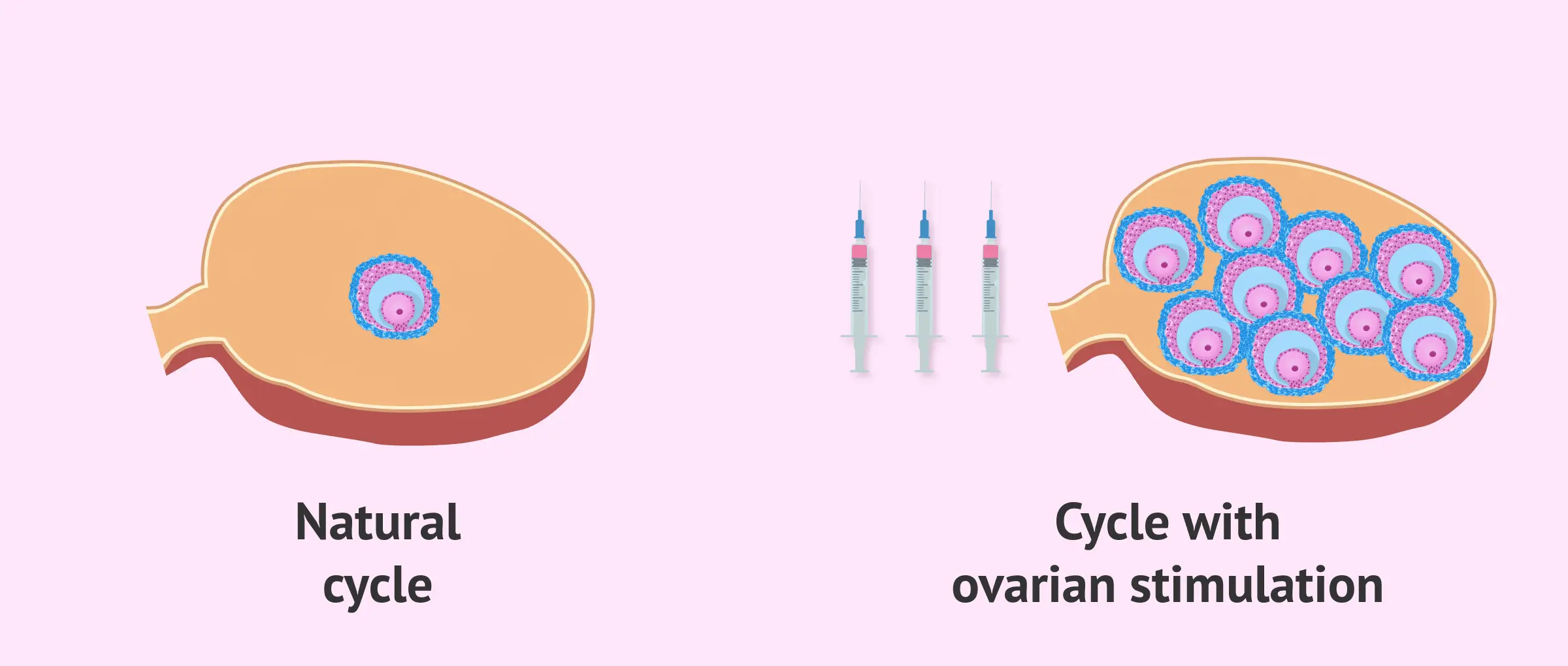 Stimulation of ovulation treatment in chennai