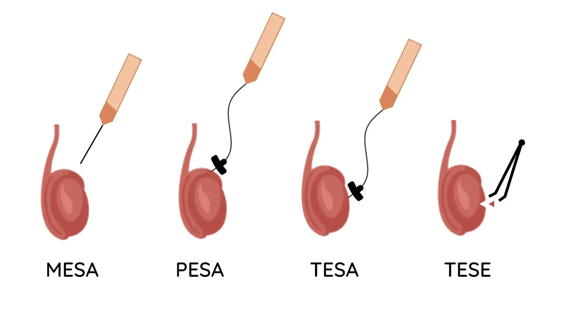 TESA/PESA Treatment Center in Chennai